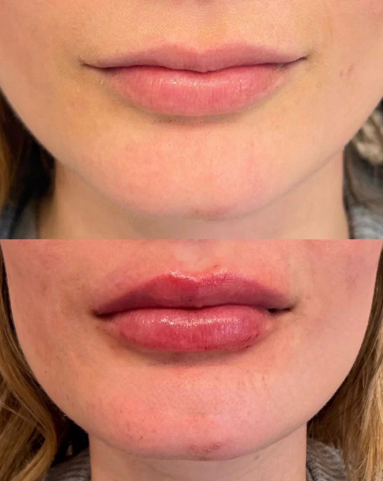 Harmonização Orofacial